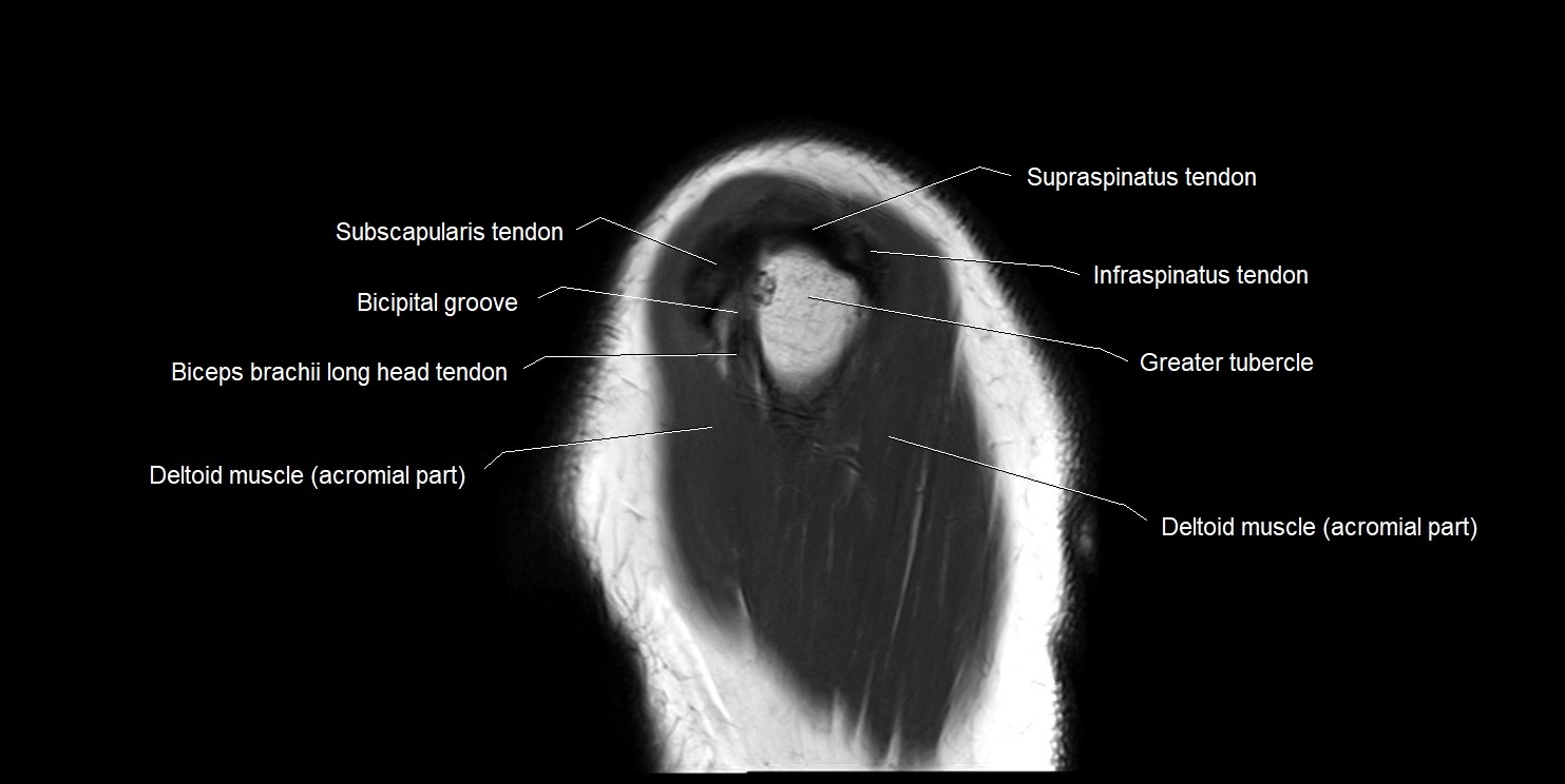 mri shoulder sagittal cross sectional anatomy image 17.webp